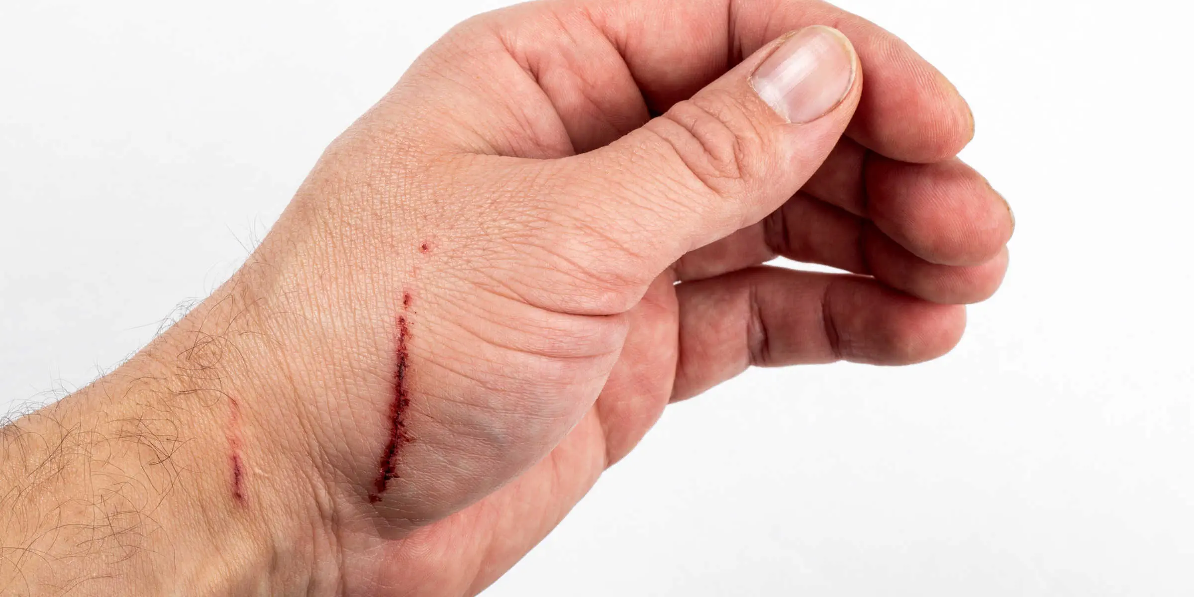 scratched hand